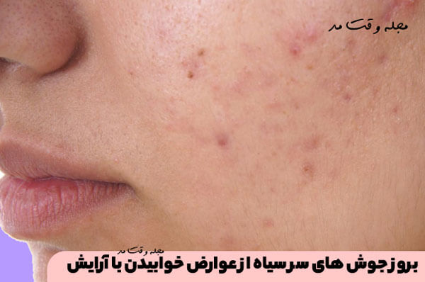 بروز جوش های سر سیاه از عوارض خوابیدن با آرایش