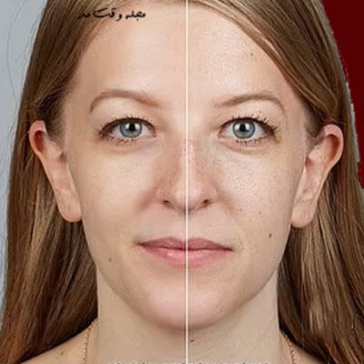 رتینول در کاهش پسوریازیس و درمان پیری پوست تاثیر دارد.