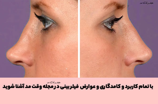 با استفاده از فیلر بینی میتوان فرورفتگی های بینی، قوز بینی، افتادگی بینی را رفع کرد.
