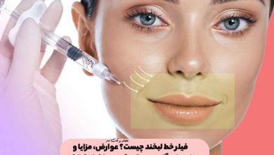 فیلر خط لبخند چیست؟ عوارض، مزایا و میزان ماندگاری تزریق پرکننده یا فیلر خط خنده