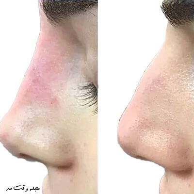راز معایت فیلر بینی یا رینوپلاستی، موقتی بودن و توانای کم در تغیر  فرم بینی است.