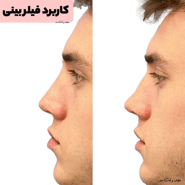 یکی از کاربرد های فیلر بینی و یا همان رینوپلاستی، از بین بردن پل بینی و زیبایی صورت است.