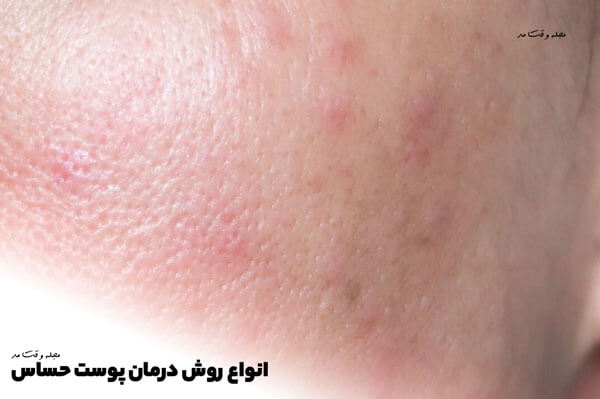 انواع روش درمان پوست حساس را در مجله vaghtemod بخوانید.