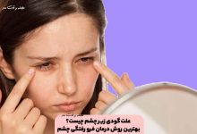 علت گودی زیر چشم چیست؟ بهترین روش درمان فرو رفتگی چشم