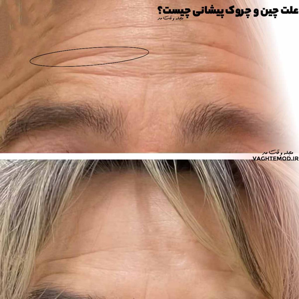 افزایش سن و اخم، از علت چین و چروک پیشانی است.
