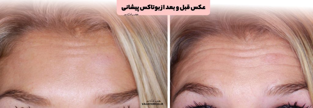 عکس و بعد از بوتاکس پیشانی