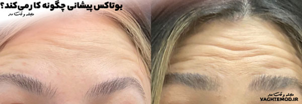بوتاکس پیشانی، عضلات پیشانی را به مدت محدود، فلج میکند.