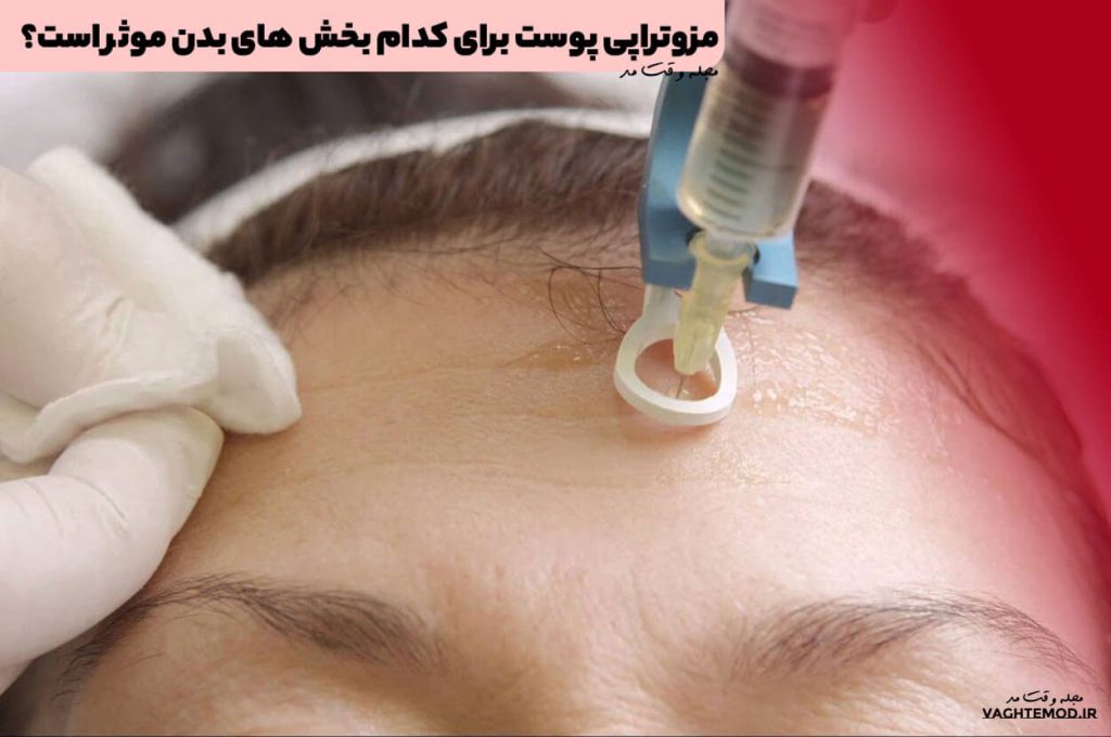 مزوتراپی پوست برای کدام بخش های بدن موثر است؟