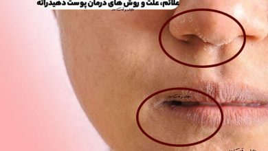 پوست دهیدراته چیست؟ علائم، علت و روش های درمان پوست دهیدراته