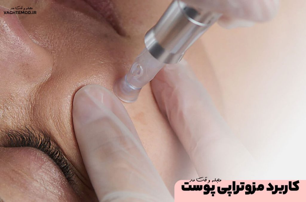 کاربرد مزوتراپی پوست صورت، از انواع کاربرد مزوتراپی پوست صورت