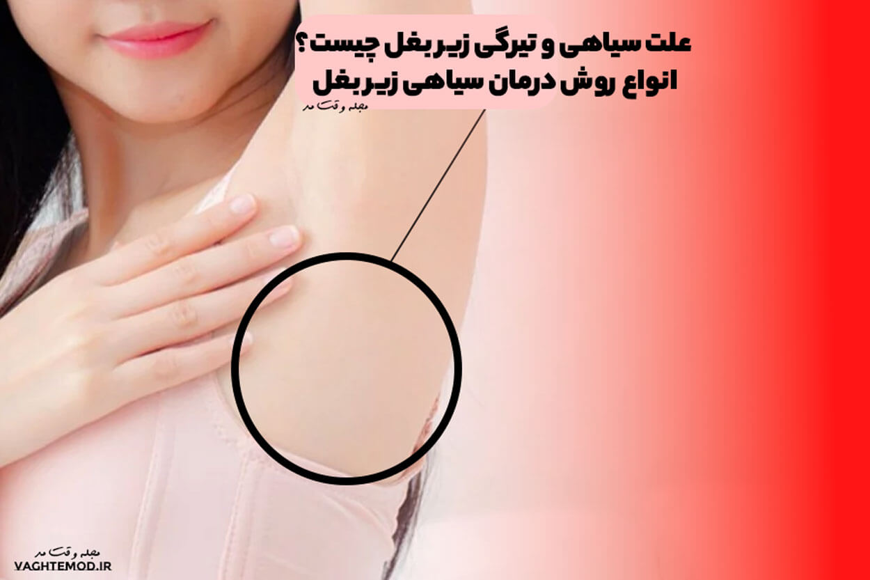 علت سیاهی و تیرگی زیر بغل چیست؟ انواع روش درمان سیاهی زیر بغل