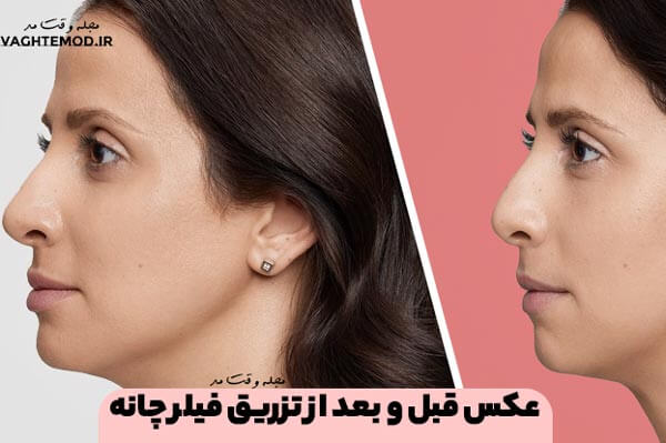 عکس قبل و بعد از تزریق فیلر چانه
