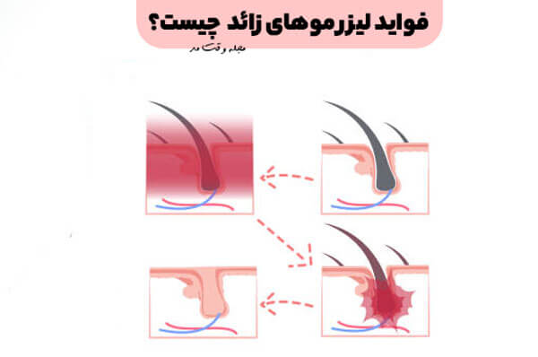 مزایا و فواید لیزر موهای زائد