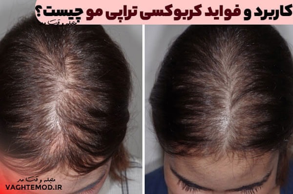 کاربرد و فواید کربوکسی تراپی مو چیست؟