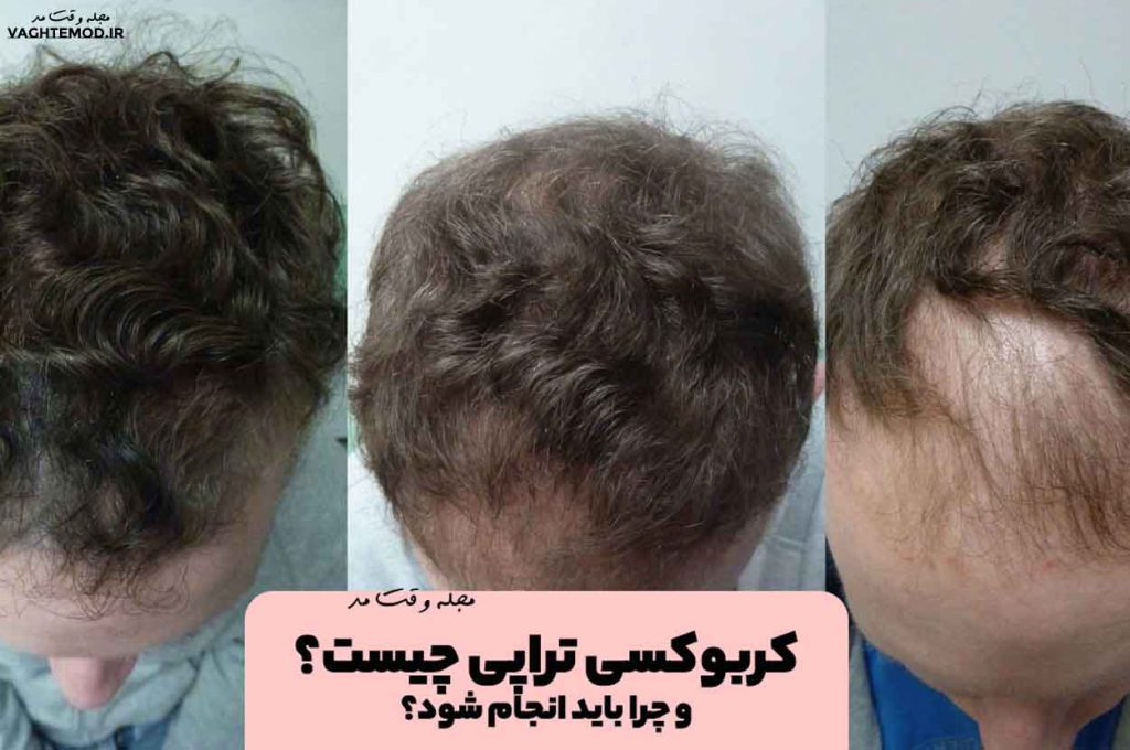 کربوکسی تراپی چیست؟