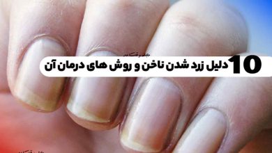 10 دلیل زرد شدن ناخن و روش های درمان آن! علائم و درمان سندرم ناخن زرد