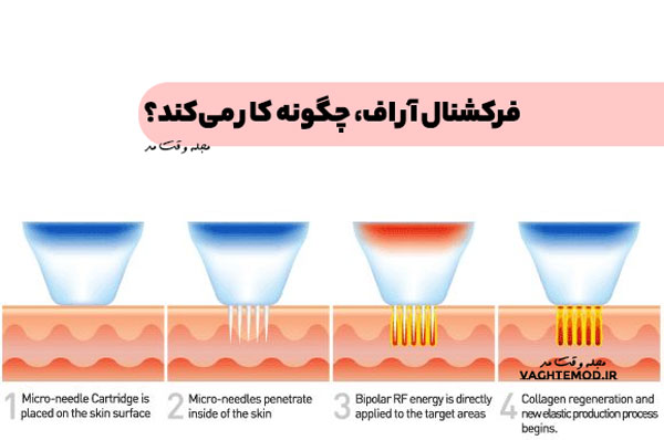 در فناوری فرکشنال RF ، میکروسوزن ها روی سطح پوست مینشینند و انرژی فرکانس رادیویی را به سطح اپیدرم پوست، ساطع میکنند