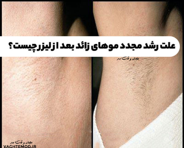 علت رشد مجدد موهای زائد بعد از لیزر