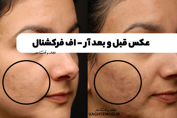عکس قبل و بعد آر اف فرکشنال