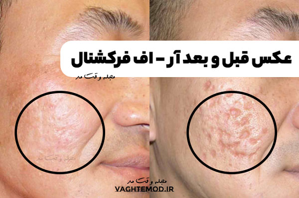 عکس قبل و بعد آر اف فرکشنال