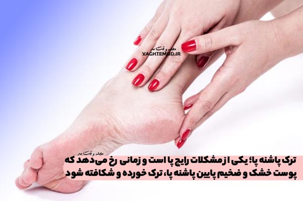 ترک پاشنه پا؛ یکی از مشکلات رایج پا است و زمانی رخ می‌دهد که پوست خشک و ضخیم پایین پاشنه پا، ترک خورده و شکافته شود