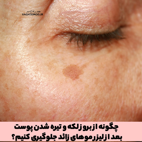 چگونه از بروز لکه و تیره شدن پوست بعد از لیزر زائد جلوگیری کنیم؟