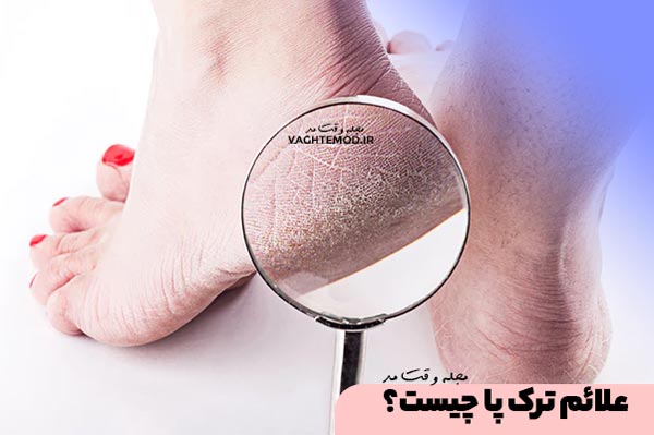 علائم ترک پا چیست؟