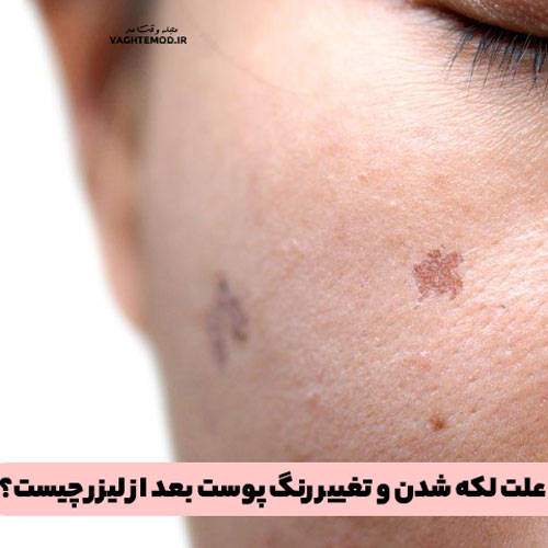 علت لکه شدن و تغییر رنگ پوست بعد از لیزر چیست؟